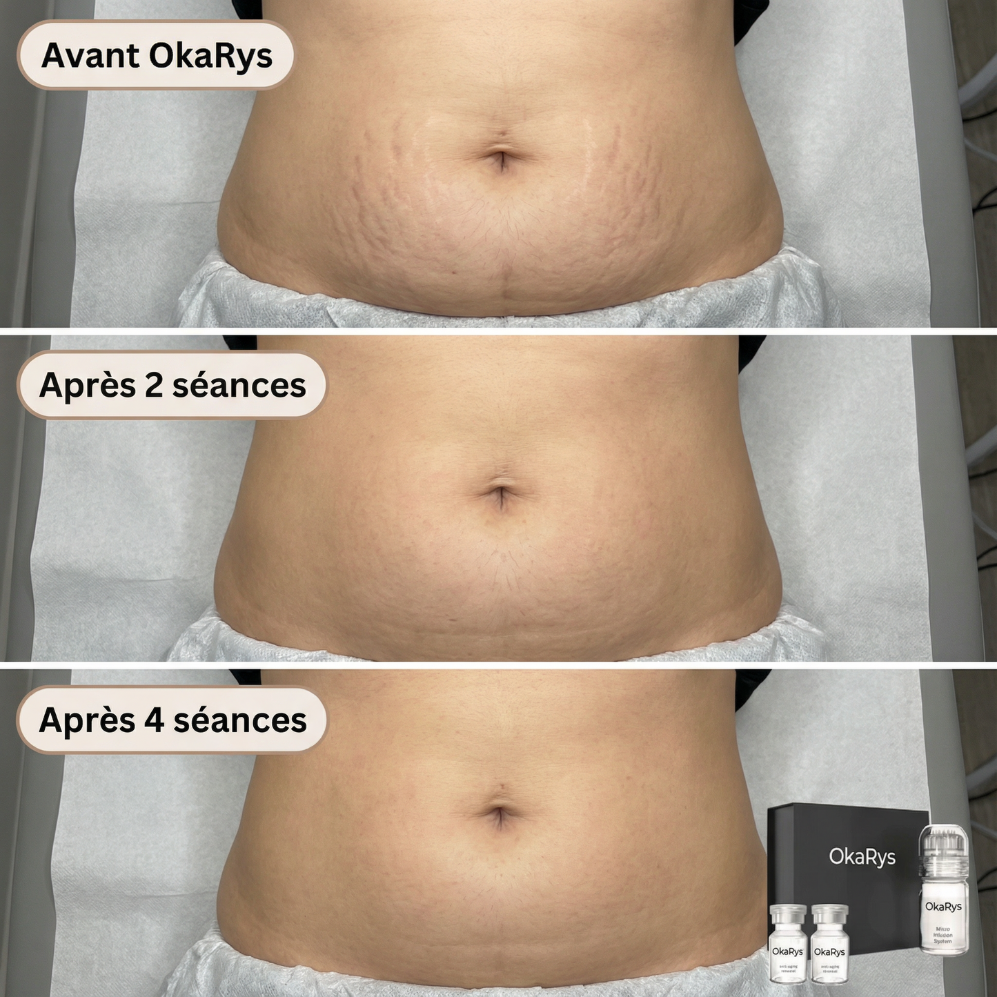 Le Rituel de micro-infusion Vergetures