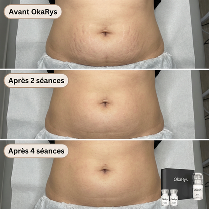 Le Rituel de micro-infusion Vergetures