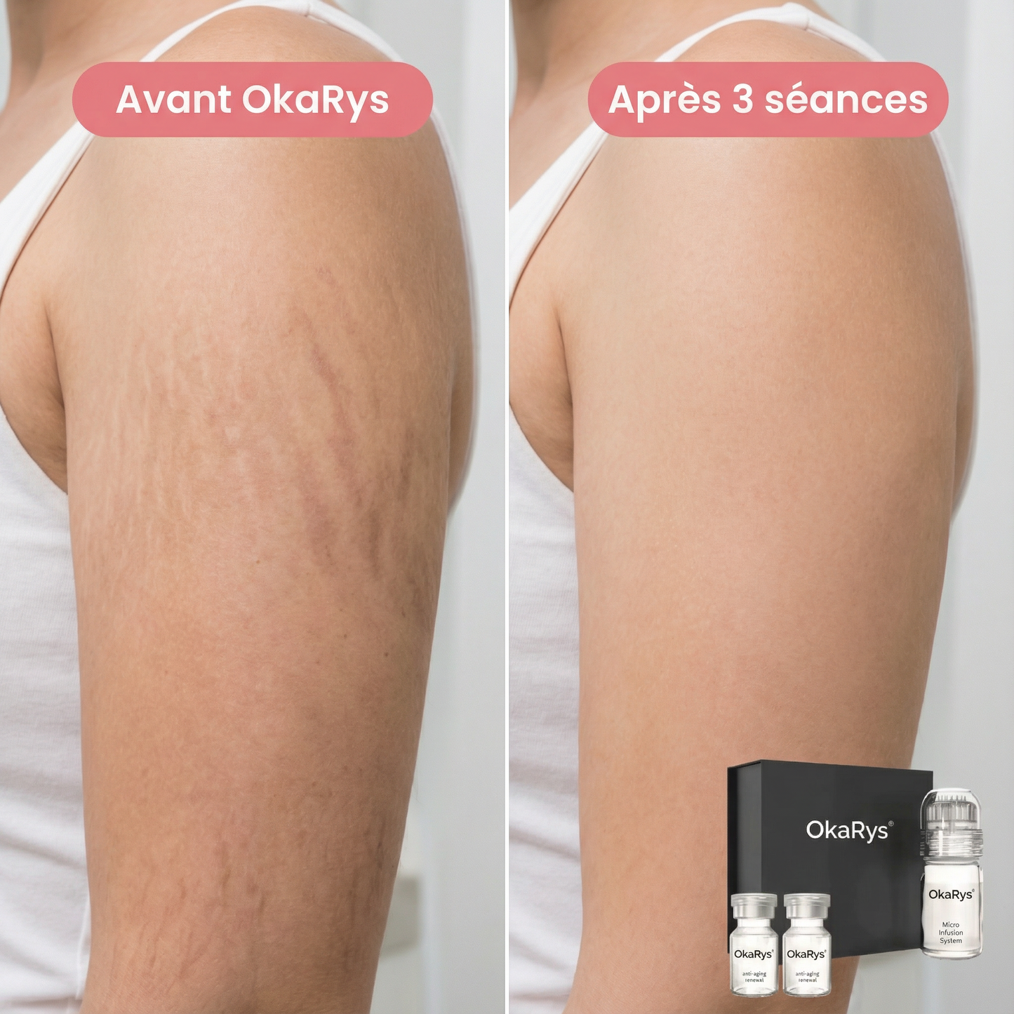 Le Rituel de micro-infusion Vergetures