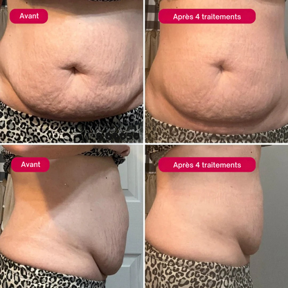 Le Rituel de micro-infusion Vergetures